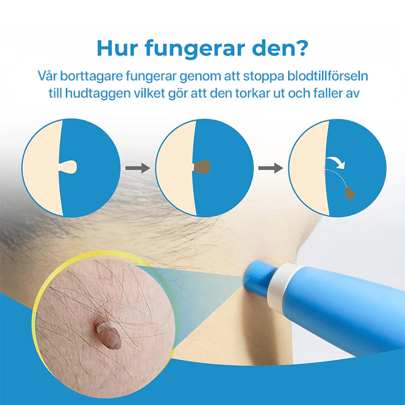 Hudfliksborttagare - Ta bort störande hudflikar enkelt hemma