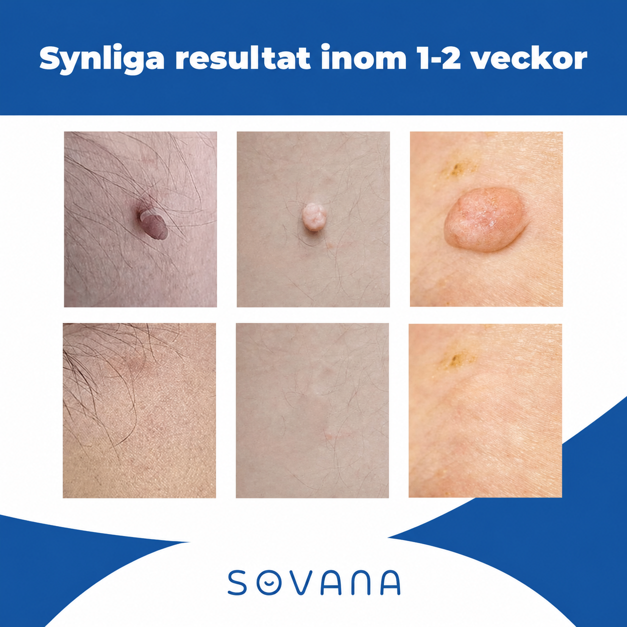 Hudfliksborttagare - Ta bort störande hudflikar enkelt hemma